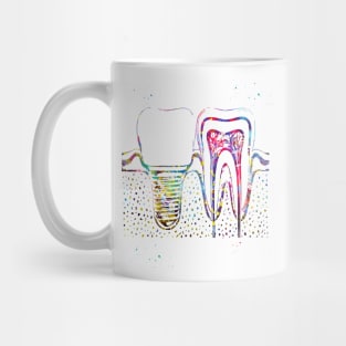 Human teeth and dental implant Mug